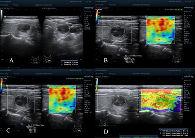 Elastography of the thyroid nodule, cut-off points between benign and malignant lesions for strain, 2D shear wave real time and point shear wave: a correlation with pathology, ACR TIRADS and Alpha Score